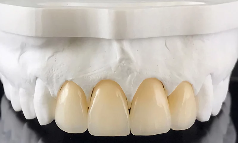 advantages-of-zirconia-teeth-implants-over-other-materials